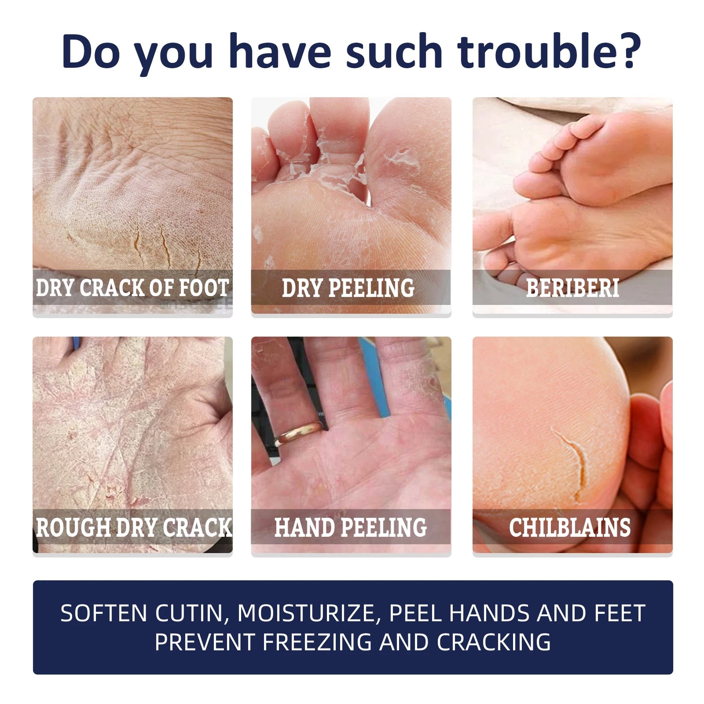 Hydrating Nourishing Cream Peeling Dry itching Repair Anti-freeze Anti Chapping Foot And Hand Care Ultra Moisturizing Cream