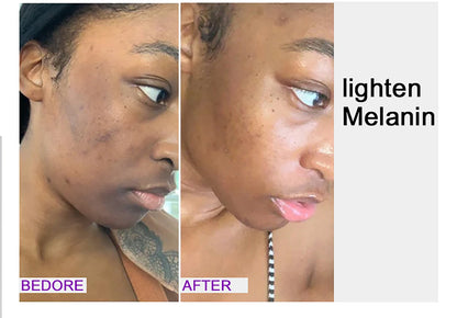 Whitening, Dark Spot & Sun Spot Removal Set, Brightening Shades, With Double Glutathione, Highly Concentrated Skin Care